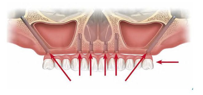 Zygoma all-on-4 FOTO: Ortoimplant