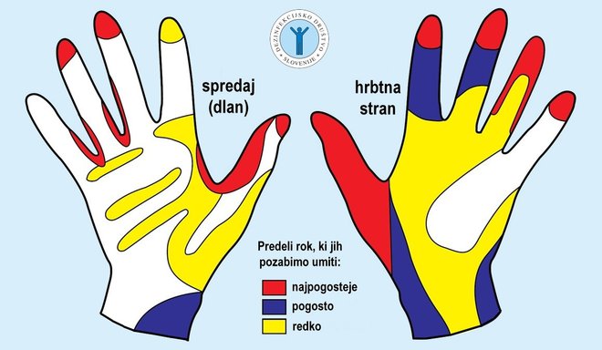 Pri umivanju rok je pomembno, da si dobro umijete predvsem tiste predele, na katere največkrat pozabite. Foto: Dezinfekcijsko društvo Slovenije