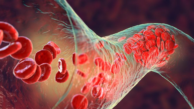 Če so vene oslabljene, se zaradi višje zunanje temperature preveč razširijo in kri v njih dodatno zastaja. FOTO: Dr_microbe/Getty Images