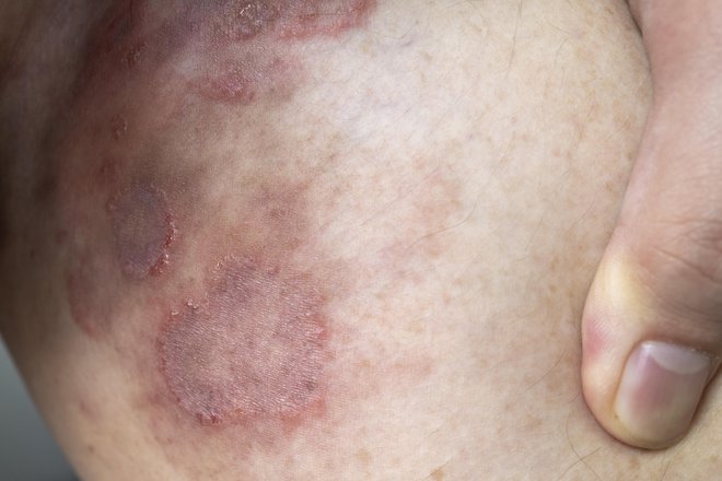 Dermatofitna okužba dimelj je lahko zelo neprijetna. FOTO: Hengdao/Getty Images