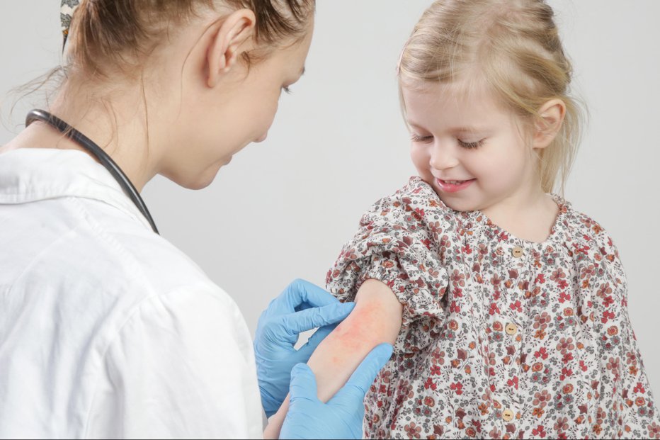 Fotografija: Bolezen naj bo pod nadzorom dermatologa. FOTO: Triocean/Getty Images