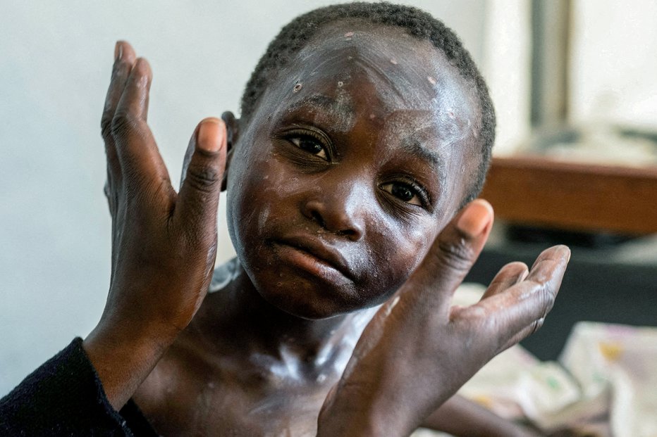 Fotografija: Demokratična republika Kongo, ena najrevnejših držav na svetu, je bila v zadnjih mesecih žarišče izbruha virusa mpox, zaradi katerega je umrlo več kot tisoč ljudi.FOTO: Arlette Bashizi Reuters